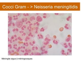 Cocci Gram - > Neisseria meningitidis Méningite aigue à méningocoques 