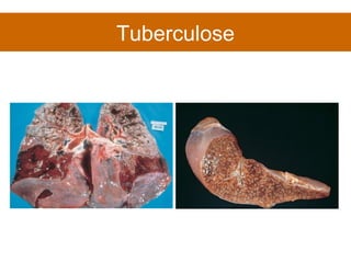 Tuberculose 