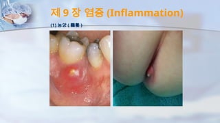제 9 장 염증 (Inflammation)
(1) 농양 ( 籠養 )
 
