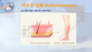 제 9 장 염증 (Inflammation)
(2) 봉와직염 (= 봉소염 , 연조직염 )
 