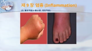 제 9 장 염증 (Inflammation)
(2) 봉와직염 (= 봉소염 , 연조직염 )
 