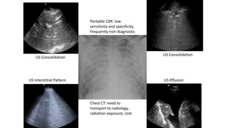 Portable CXR: low
sensitivity and specificity,
frequently non-diagnostic
Chest CT: need to
transport to radiology,
radiation exposure, cost
US Consolidation
US Effusion
US Consolidation
US Interstitial Pattern
 