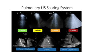 Pulmonary US Scoring System
 