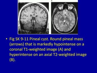 9 masses in the pineal region | PPTX