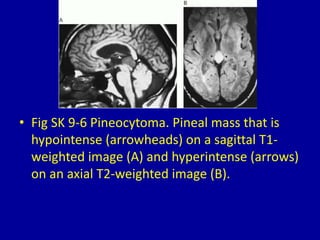9 masses in the pineal region | PPTX
