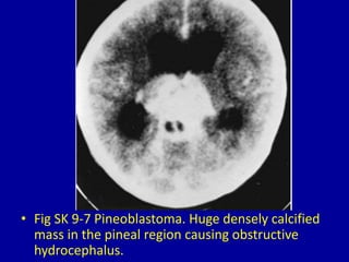 9 masses in the pineal region | PPTX
