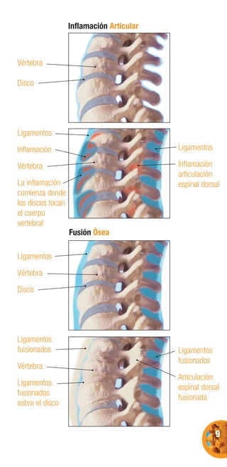 9
Vértebra
Disco
Ligamentos
Inﬂamación
Vértebra
La inﬂamación
comienza donde
los discos tocan
el cuerpo
vertebral
Ligamentos
Vértebra
Disco
Ligamentos
fuisionados
Vértebra
Ligamentos
fusionados
sobre el disco
Ligamentos
Inﬂamación
articulación
espinal dorsal
Ligamentos
fusionados
Articulación
espinal dorsal
fusionada
Inﬂamación Articular
Fusión Ósea
 