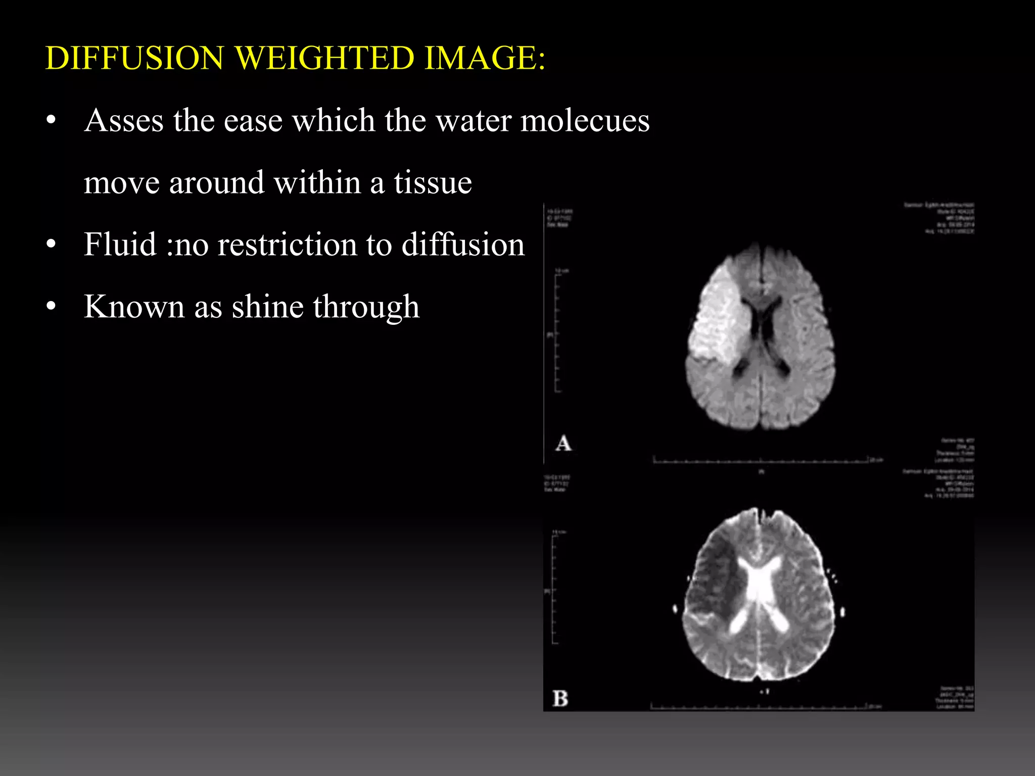 DIFFUSION WEIGHTED IMAGE:
• Asses the ease which the water molecues
move around within a tissue
• Fluid :no restriction to diffusion
• Known as shine through
 