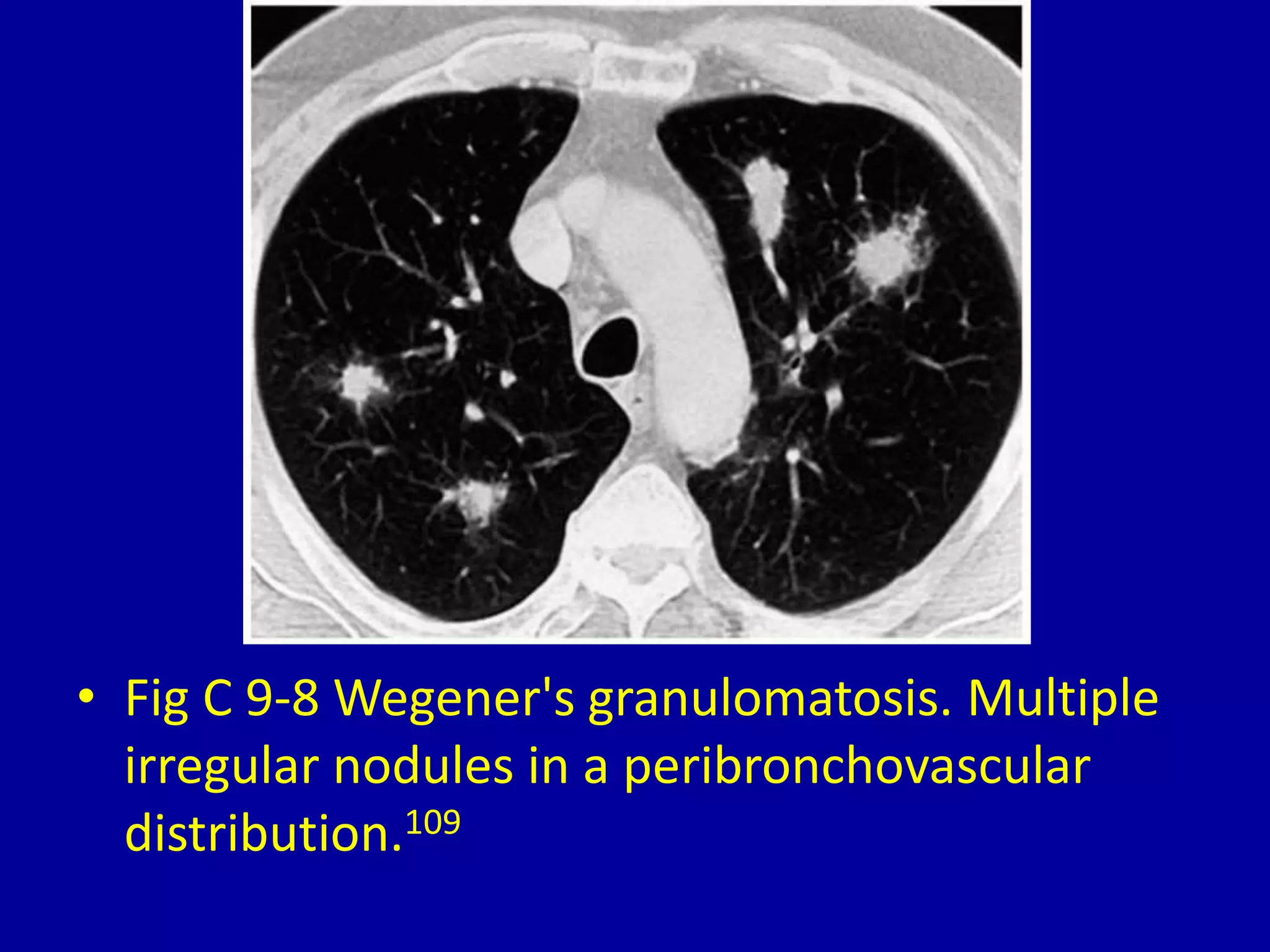 9 multiple pulmonary nodules on computed tomography | PPTX