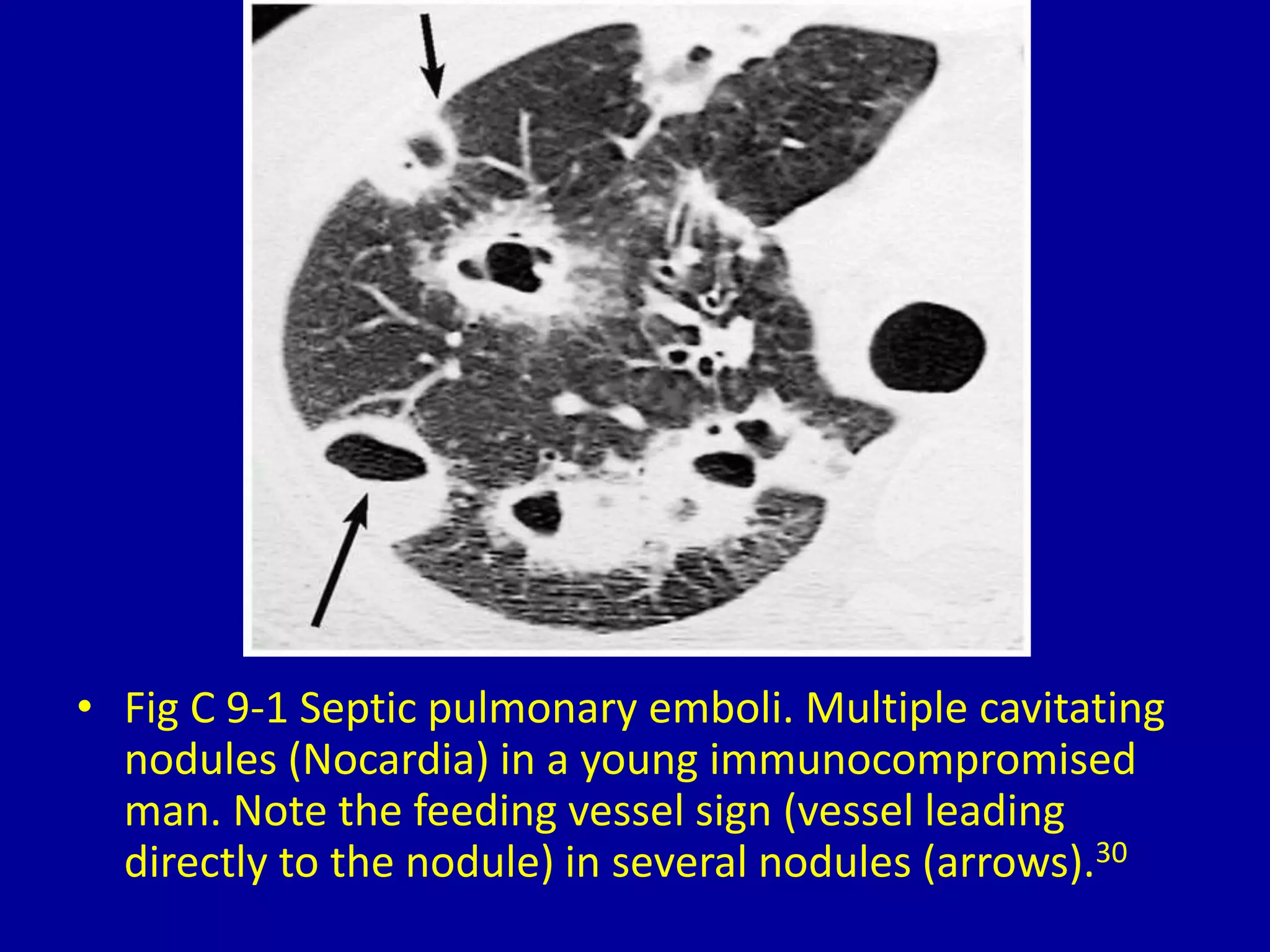 9 multiple pulmonary nodules on computed tomography | PPTX
