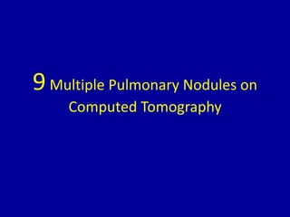 9Multiple Pulmonary Nodules on
Computed Tomography
 
