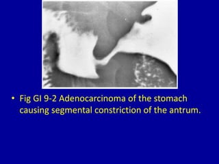 9 narrowing of the stomach | PPTX