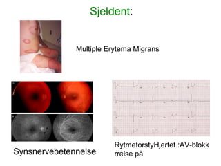 Synsnervebetennelse
RytmeforstyHjertet :AV-blokk
rrelse på
Multiple Erytema Migrans
Sjeldent:
 