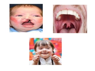 NONSUPPURATIVE OTITIS MEDIA | PPTX