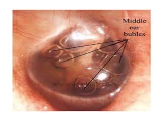 NONSUPPURATIVE OTITIS MEDIA | PPTX