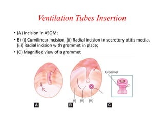 NONSUPPURATIVE OTITIS MEDIA | PPTX