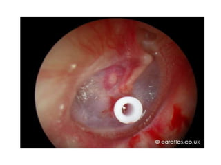 NONSUPPURATIVE OTITIS MEDIA | PPTX