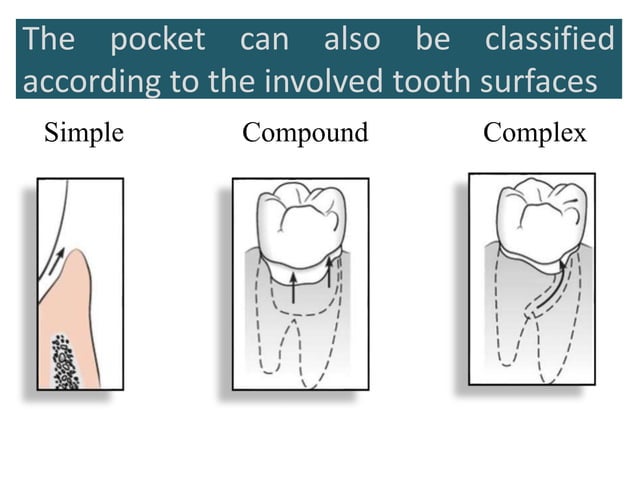 Periodontal pocket