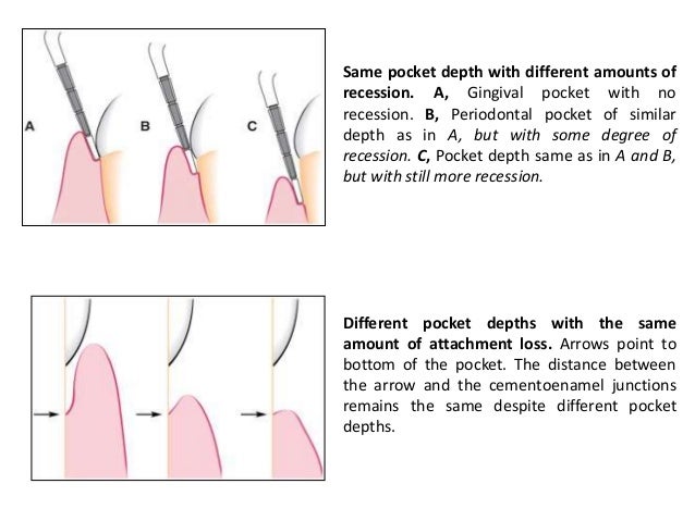 Periodontal Pockets Form Due To Periodontal Pockets Form Due To