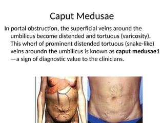 Caput Med 9 Portal-vein-an-portocaval-anastomosis.pptx