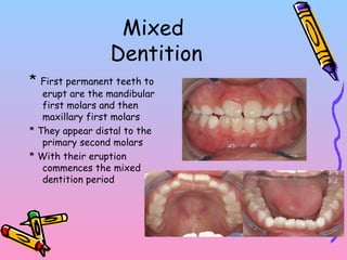 Mixed
Dentition
* First permanent teeth to
erupt are the mandibular
first molars and then
maxillary first molars
* They appear distal to the
primary second molars
* With their eruption
commences the mixed
dentition period
 