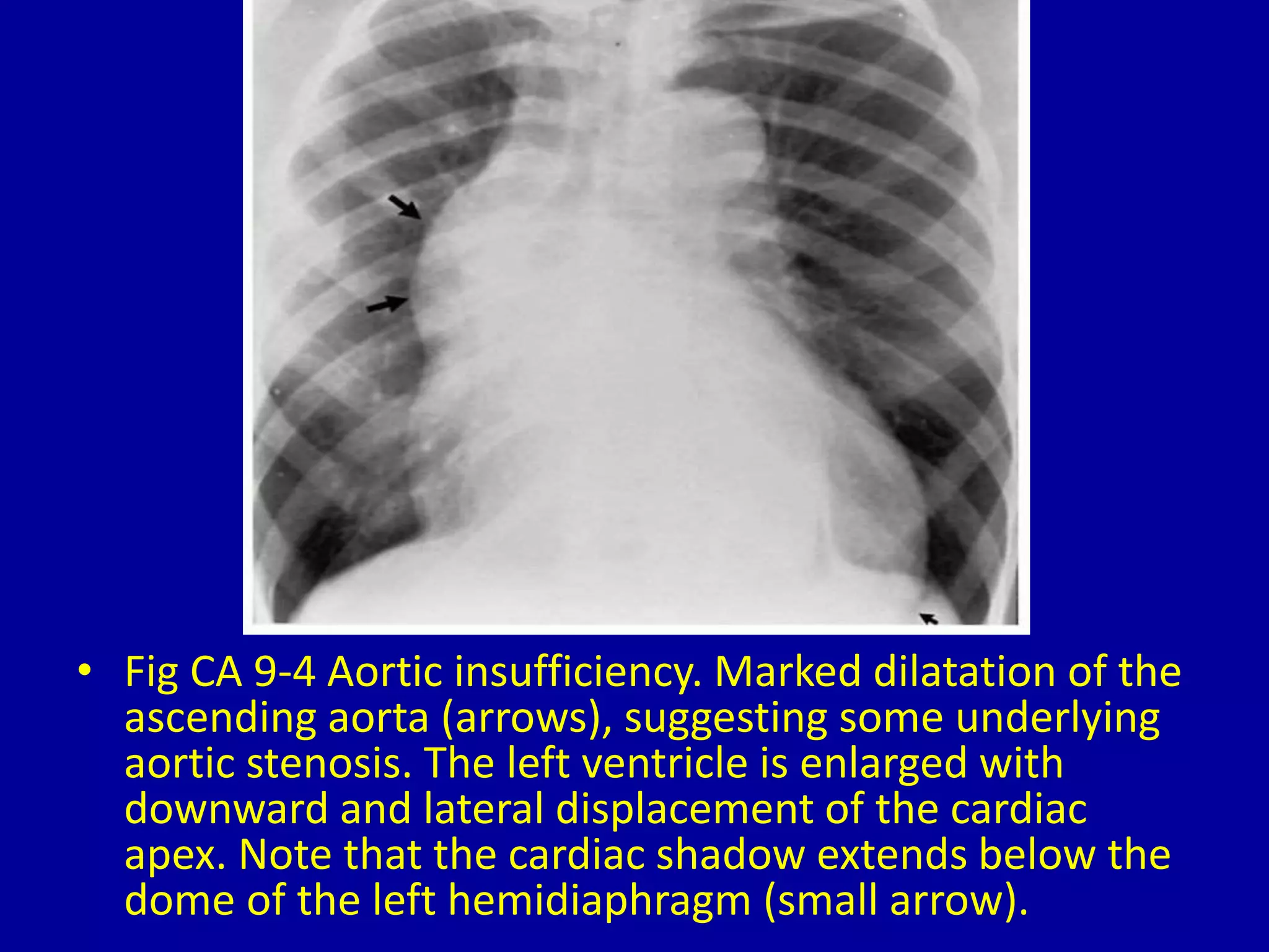 Aortic Shadow 9 prominent ascending aorta or aortic arch | PPTX