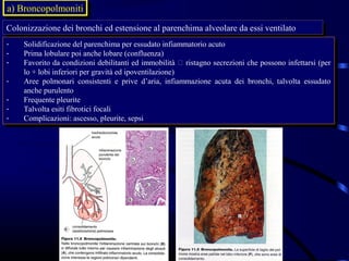 a) Broncopolmoniti
 a) Broncopolmoniti
Colonizzazione dei bronchi ed estensione al parenchima alveolare da essi ventilato
 Colonizzazione dei bronchi ed estensione al parenchima alveolare da essi ventilato
--   Solidificazione del parenchima per essudato infiammatorio acuto
      Solidificazione del parenchima per essudato infiammatorio acuto
--   Prima lobulare poi anche lobare (confluenza)
      Prima lobulare poi anche lobare (confluenza)
--   Favorito da condizioni debilitanti ed immobilità  ristagno secrezioni che possono infettarsi (per
      Favorito da condizioni debilitanti ed immobilità  ristagno secrezioni che possono infettarsi (per
     lo ++lobi inferiori per gravità ed ipoventilazione)
      lo lobi inferiori per gravità ed ipoventilazione)
--   Aree polmonari consistenti ee prive d’aria, infiammazione acuta dei bronchi, talvolta essudato
      Aree polmonari consistenti prive d’aria, infiammazione acuta dei bronchi, talvolta essudato
     anche purulento
      anche purulento
--   Frequente pleurite
      Frequente pleurite
--   Talvolta esiti fibrotici focali
      Talvolta esiti fibrotici focali
--   Complicazioni: ascesso, pleurite, sepsi
      Complicazioni: ascesso, pleurite, sepsi
 