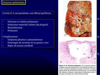 Ascesso polmonare
Ascesso polmonare


Cavità (2-3 cm) purulenta, con fibrosi periferica
 Cavità (2-3 cm) purulenta, con fibrosi periferica


--   Infezioni su infarto polmonare
      Infezioni su infarto polmonare
--   Inalazione materiale infetto (da piogeni)
      Inalazione materiale infetto (da piogeni)
--   Bronchiectasie
      Bronchiectasie
--   Polmoniti
      Polmoniti

Complicazioni:
 Complicazioni:
-- Empiema pleurico eepneumotorace
    Empiema pleurico pneumotorace
-- Emorragia da erosione di un grosso vaso
    Emorragia da erosione di un grosso vaso
-- Sepsi ed ascessi cerebrali
    Sepsi ed ascessi cerebrali
 