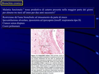 Bronchite cronica
Bronchite cronica

Malattia funzionale:” tosse produttiva di catarro presente nella maggior parte dei giorni
 Malattia funzionale:” tosse produttiva di catarro presente nella maggior parte dei giorni
per almeno tre mesi all’anno per due anni successivi”
 per almeno tre mesi all’anno per due anni successivi”
Restrizione del lume bronchiale ed intasamento da parte di muco
 Restrizione del lume bronchiale ed intasamento da parte di muco
Ipoventilazione alveolare, ipossiemia ed ipercapnia (insuff. respiratoria tipo II)
 Ipoventilazione alveolare, ipossiemia ed ipercapnia (insuff. respiratoria tipo II)
Cianosi senza dispnea
 Cianosi senza dispnea
Cuore polmonare
 Cuore polmonare
 