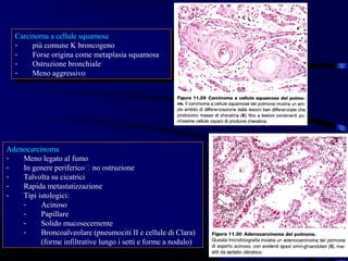Carcinoma aacellule squamose
   Carcinoma cellule squamose
  --   più comune K broncogeno
        più comune K broncogeno
  --   Forse origina come metaplasia squamosa
        Forse origina come metaplasia squamosa
  --   Ostruzione bronchiale
        Ostruzione bronchiale
  --   Meno aggressivo
        Meno aggressivo




Adenocarcinoma
 Adenocarcinoma
--  Meno legato al fumo
     Meno legato al fumo
--  In genere periferico no ostruzione
     In genere periferico no ostruzione
--  Talvolta su cicatrici
     Talvolta su cicatrici
--  Rapida metastatizzazione
     Rapida metastatizzazione
--  Tipi istologici:
     Tipi istologici:
    --    Acinoso
           Acinoso
    --    Papillare
           Papillare
    --    Solido mucosecernente
           Solido mucosecernente
    --    Broncoalveolare (pneumociti II eecellule di Clara)
           Broncoalveolare (pneumociti II cellule di Clara)
          (forme infiltrative lungo i isetti eeforme aanodulo)
           (forme infiltrative lungo setti forme nodulo)
 