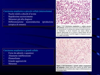 Carcinoma anaplastico aapiccole cellule (microcitoma)
 Carcinoma anaplastico piccole cellule (microcitoma)
--   Nuclei simili aachicchi d’avena
      Nuclei simili chicchi d’avena
--   Rapidissimo accrescimento
      Rapidissimo accrescimento
--   Metastasi già alla diagnosi
      Metastasi già alla diagnosi
--   Differenziazione neuroendocrina (produzione
      Differenziazione neuroendocrina (produzione
     ectopica di ormoni)
      ectopica di ormoni)




Carcinoma anaplastico aagrandi cellule
 Carcinoma anaplastico grandi cellule
--   Forse da adenok oosquamosi
      Forse da adenok squamosi
--   Altamente indifferenziati
      Altamente indifferenziati
--   Plomorfismo
      Plomorfismo
--   Grande aggressività
      Grande aggressività
--   Metastasi
      Metastasi
 