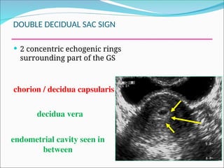 Chorionic Ring Obstetrics Role of Imaging in Obs.(1).ppt