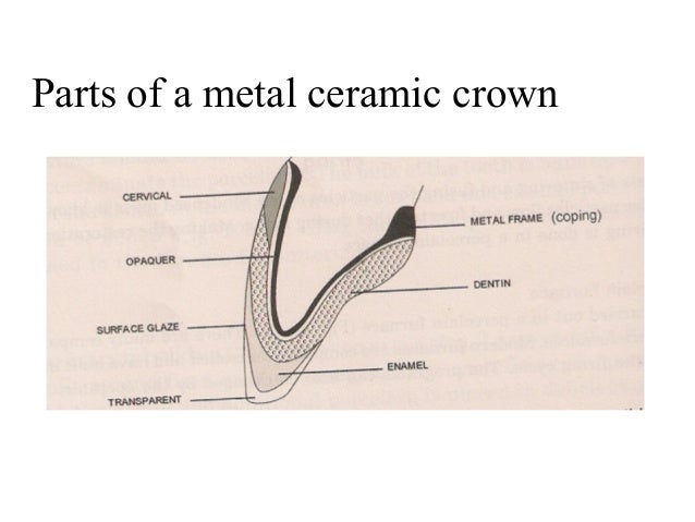 Tooth Preparation For Metal Ceramic Crowns