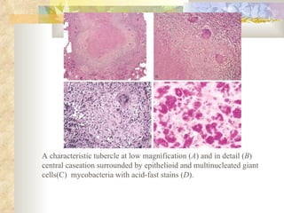A characteristic tubercle at low magnification ( A ) and in detail ( B ) central caseation surrounded by epithelioid and multinucleated giant cells(C)  mycobacteria with acid-fast stains ( D ).  