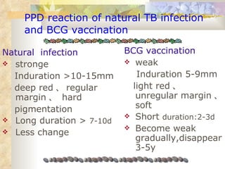 PPD reaction of natural TB infection  and BCG vaccination Natural  infection stronge Induration  >10-15mm deep red 、 regular margin 、  hard pigmentation Long duration >  7-10d Less change  BCG vaccination weak Induration  5-9mm light red 、  unregular margin 、 soft Short  duration:2-3d Become weak gradually,disappear3-5y 