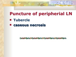 Puncture of peripherial LN Tubercle caseous necrosis 