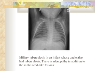 Miliary tuberculosis in an infant whose uncle also had tuberculosis. There is adenopathy in addition to the millet seed–like lesions  