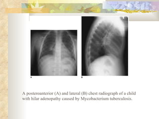 A posteroanterior (A) and lateral (B) chest radiograph of a child with hilar adenopathy caused by Mycobacterium tuberculosis. 