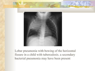 Lobar pneumonia with bowing of the horizontal fissure in a child with tuberculosis. a secondary bacterial pneumonia may have been present  