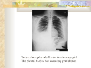 Tuberculous pleural effusion in a teenage girl. The pleural biopsy had caseating granulomas 