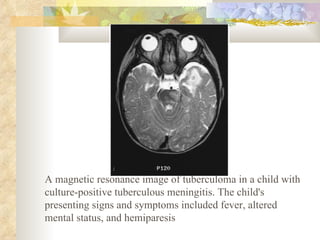 A magnetic resonance image of tuberculoma in a child with culture-positive tuberculous meningitis. The child's presenting signs and symptoms included fever, altered mental status, and hemiparesis  
