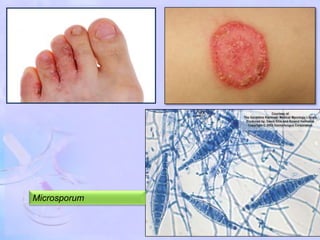 Microsporum
 