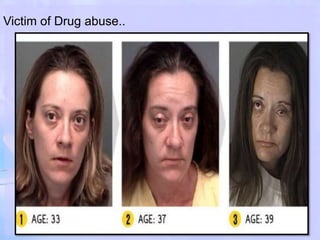 Victim of Drug abuse..
 