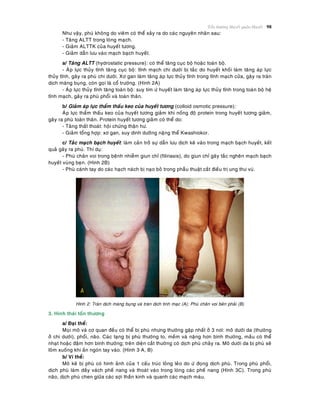 Toån thöông Huyeát quaûn-Huyeát 98
Nhö vaäy, phuø khoâng do vieâm coù theå xaûy ra do caùc nguyeân nhaân sau:
- Taêng ALTT trong loøng maïch.
- Giaûm ALTTK cuûa huyeát töông.
- Giaûm daãn löu vaøo maïch baïch huyeát.
a/ Taêng ALTT (hydrostatic pressure): coù theå taêng cuïc boä hoaëc toaøn boä.
- AÙp löïc thuûy tónh taêng cuïc boä: tónh maïch chi döôùi bò taéc do huyeát khoái laøm taêng aùp löïc
thuûy tónh, gaây ra phuø chi döôùi. Xô gan laøm taêng aùp löïc thuûy tónh trong tónh maïch cöûa, gaây ra traøn
dòch maøng buïng, coøn goïi laø coå tröôùng. (Hình 2A)
- AÙp löïc thuûy tónh taêng toaøn boä: suy tim öù huyeát laøm taêng aùp löïc thuûy tónh trong toaøn boä heä
tónh maïch, gaây ra phuø phoåi vaø toaøn thaân.
b/ Giaûm aùp löïc thaåm thaáu keo cuûa huyeát töông (colloid osmotic pressure):
AÙp löïc thaåm thaáu keo cuûa huyeát töông giaûm khi noàng ñoä protein trong huyeát töông giaûm,
gaây ra phuø toaøn thaân. Protein huyeát töông giaûm coù theå do:
- Taêng thaát thoaùt: hoäi chöùng thaän hö.
- Giaûm toång hôïp: xô gan, suy dinh döôõng naëng theå Kwashiokor.
c/ Taéc maïch baïch huyeát: laøm caûn trôû söï daãn löu dòch keõ vaøo trong maïch baïch huyeát, keát
quaû gaây ra phuø. Thí duï:
- Phuø chaân voi trong beänh nhieãm giun chæ (filiriasis), do giun chæ gaây taéc ngheõn maïch baïch
huyeát vuøng beïn. (Hình 2B)
- Phuø caùnh tay do caùc haïch naùch bò naïo boû trong phaãu thuaät caét ñieàu trò ung thö vuù.
Hình 2: Traøn dòch maøng buïng vaø traøn dòch tinh maïc (A); Phuø chaân voi beân phaûi (B)
3. Hình thaùi toån thöông
a/ Ñaïi theå:
Moïi moâ vaø cô quan ñeàu coù theå bò phuø nhöng thöôøng gaëp nhaát ôû 3 nôi: moâ döôùi da (thöôøng
ôû chi döôùi), phoåi, naõo. Caùc taïng bò phuø thöôøng to, meàm vaø naëng hôn bình thöôøng, maàu coù theå
nhaït hoaëc ñaäm hôn bình thöôøng; treân dieän caét thöôøng coù dòch phuø chaûy ra. Moâ döôùi da bò phuø seõ
loõm xuoáng khi aán ngoùn tay vaøo. (Hình 3 A, B)
b/ Vi theå:
Moâ keõ bò phuø coù hình aûnh cuûa 1 caáu truùc loûng leûo do öù ñoïng dòch phuø. Trong phuø phoåi,
dòch phuø laøm daày vaùch pheá nang vaø thoaùt vaøo trong loøng caùc pheá nang (Hình 3C). Trong phuø
naõo, dòch phuø chen giöõa caùc sôïi thaàn kinh vaø quanh caùc maïch maùu.
 