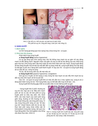 Toån thöông Huyeát quaûn-Huyeát 99
Hình 3: Ñaïi theå vaø vi theå cuûa phuø moâ döôùi da chi döôùi (A,B);
Phuø phoåi do suy tim, loøng pheá nang öù dòch phuø maàu hoàng (C).
II. SUNG HUYEÁT
1. Ñònh nghóa
Laø tình traïng gia taêng quaù möùc löôïng maùu chöùa trong moâ - cô quan.
2. Hình thaùi toån thöông
Phaân bieät 2 loaïi sung huyeát
a/ Sung huyeát ñoäng (active hyperemia):
Laø söï gia taêng quaù möùc löôïng maùu vaøo heä thoáng mao maïch do söï giaõn nôû caùc ñoäng
maïch vaø tieåu ñoäng maïch. Nguyeân nhaân cuûa giaõn nôû naøy coù theå do taùc ñoäng cuûa caùc chaát trung
gian hoùa hoïc (nhö trong vieâm caáp tính) hoaëc do kích thích thaàn kinh vaän maïch. Sung huyeát ñoäng
seõ laøm taêng chuyeån hoùa teá baøo taïi choã daãn ñeán söï taêng nhieät ñoä, sung huyeát ñoäng möùc ñoä naëng
coù theå gaây ra phuø do öù ñoïng dòch xuaát thanh huyeát. Vì vaäy caùc moâ - cô quan bò sung huyeát ñoäng
seõ coù maàu ñoû röïc, noùng vaø söng.
Thí duï: ñoû da trong vieâm da, ñoû maët maéc côõ.
b/ Sung huyeát tónh (passive hyperemia= congestion):
Coøn goïi laø öù huyeát, laø tình traïng öù maùu trong heä mao maïch vaø caùc tieåu tónh maïch do söï
daãn löu maùu tónh maïch veà tim bò caûn trôû.
Caùc moâ - cô quan bò sung huyeát tónh coù maàu ñoû xaãm do öù maùu ngheøo oxy, söng to do öù
ñoïng dòch thaám trong moâ keõ. Tình traïng thieáu oxy coù theå daãn ñeán hoaïi töû teá baøo - moâ.
Sung huyeát tónh thöôøng gaëp nhaát vaø coù bieåu hieän roõ reät nhaát taïi phoåi vaø gan.
- Sung huyeát tónh ôû phoåi: thöôøng do
suy tim traùi, heïp van 2 laù. Maùu tónh maïch
phoåi veà tim bò caûn trôû laøm phoåi bò sung
huyeát; phoåi coù maàu naâu xaãm, raén. Döôùi
KHV, caùc mao maïch cuûa vaùch pheá nang
giaõn roäng, thöôøng coù toån thöông noäi moâ
laøm thoaùt hoàng caàu vaøo loøng pheá nang. Vì
vaäy trong loøng pheá nang coù caùc “teá baøo
suy tim” (heart failure cell) töùc laø caùc ñaïi
thöïc baøo pheá nang chöùa nhieàu saéc toá
hemosiderin trong baøo töông, keát quaû cuûa
hoaït ñoäng phaân huûy hemoglobin cuûa hoàng
caàu ñöôïc thöïc baøo. (Hình 4)
Hình 4: A.Sung huyeát tónh ôû phoåi keùo daøi, loøng pheá nang
coù caùc “teá baøo suy tim” (muõi teân). B. Teá baøo suy tim ôû ñoä
phoùng ñaïi lôùn, baøo töông öù ñaày hemosiderin.
 
