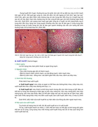 Toån thöông Huyeát quaûn-Huyeát 100
- Sung huyeát tónh ôû gan: thöôøng do suy tim phaûi, laøm caûn trôû söï daãn löu maùu töø tónh maïch
treân gan veà tim. Keát quaû gan söng to, maàu ñoû xaãm; khi caét ngang coù hình aûnh “gan haït cau”
(Hình 5A), goàm caùc ñaùm thaãm maàu (töông öùng vôùi caùc trung taâm tieåu thuøy bò öù huyeát hoaïi töû)
xen keõ vôùi caùc ñaùm nhaït maàu (töông öùng vôùi caùc vuøng teá baøo gan coøn bình thöôøng hoaëc thoaùi
hoùa môõ). Döôùi KHV, caùc xoang mao maïch gan giaõn roäng do öù huyeát; do tình traïng thieáu oxy ôû
trung taâm tieåu thuøy naëng hôn vuøng quanh khoaûng cöûa neân caùc teá baøo gan ôû vuøng trung taâm
thöôøng bò hoaïi töû tröôùc trong khi caùc teá baøo gan quanh khoaûng cöûa vaãn coøn töông ñoái bình
thöôøng hoaëc chæ bò thoaùi hoùa môõ. (Hình 5B)
Hình 5: Hình aûnh “gan haït cau” (A); treân vi theå, hoaïi töû teá baøo gan ôû quanh tónh maïch trung taâm tieåu thuyø(*)
naëng hôn vuøng quanh khoaûng cöûa (muõi teân) (B)
III. XUAÁT HUYEÁT (hemorrhage):
1. Ñònh nghóa
Laø tình traïng maùu toaøn phaàn thoaùt ra ngoaøi loøng maïch.
2. Nguyeân nhaân
- Caùc chaán thöông gaây ñöùt vôõ thaønh maïch.
- Beänh lyù thaønh maïch: phình maïch, xô vöõa ñoäng maïch, vieâm maïch maùu.
- Beänh lyù caàm maùu - ñoâng maùu: caùc beänh giaûm tieåu caàu maùu, beänh öa chaûy maùu.
3. Hình thaùi toån thöông
Phaân bieät 2 loaïi xuaát huyeát:
a/ Xuaát huyeát ngoaïi: maùu chaûy ra ngoaøi cô theå theo caùc ñöôøng khaùc nhau: chaûy maùu muõi,
xuaát huyeát tieâu hoùa, chaûy maùu ñöôøng sinh duïc, v.v.
b/ Xuaát huyeát noäi: maùu thoaùt ra khoûi loøng maïch nhöng vaãn coøn naèm trong cô theå. Maùu coù
theå tích tuï trong caùc khoang töï nhieân gaây ra traøn maùu maøng tim, traøn maùu maøng phoåi, traøn maùu
maøng buïng, traøn maùu bao khôùp. Maùu coù theå xaâm nhaäp vaøo caùc moâ döôùi da vaø nieâm maïc; bieåu
hieän döôùi nhieàu daïng khaùc nhau nhö ñoám xuaát huyeát, ban xuaát huyeát, baàm maùu, oå maùu tuï (Hình
6).
Döôùi KHV, bieåu hieän cuûa xuaát huyeát laø söï hieän dieän cuûa hoàng caàu beân ngoaøi maïch maùu.
4/ Haäu quaû cuûa xuaát huyeát:
Tuøy thuoäc soá löôïng maùu bò maát, toác ñoä xuaát huyeát vaø vò trí xuaát huyeát:
Thí duï: xuaát huyeát nhanh vaø nhieàu ( > 20% theå tích maùu) coù theå gaây ra tình traïng soác giaûm
theå tích vaø töû vong; cuøng löôïng maùu maát nhöng xuaát huyeát trong naõo seõ coù haäu quaû naëng hôn
xuaát huyeát döôùi da.
 