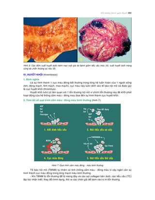 Toån thöông Huyeát quaûn-Huyeát 101
Hình 6: Caùc ñoám xuaát huyeát döôùi nieâm maïc ruoät giaø do beänh giaûm tieåu caàu maùu (A); xuaát huyeát döôùi maøng
cöùng do chaán thöông soï naõo (B).
IV. HUYEÁT KHOÁI (thrombosis):
1. Ñònh nghóa
Laø söï hình thaønh 1 cuïc maùu ñoâng baát thöôøng trong loøng heä tuaàn hoaøn cuûa 1 ngöôøi soáng
(tim, ñoäng maïch, tónh maïch, mao maïch); cuïc maùu naøy luoân dính vaøo teá baøo noäi moâ vaø ñöôïc goïi
laø cuïc huyeát khoái (thrombus).
Huyeát khoái luoân coù lieân quan vôùi 1 toån thöông noäi moâ vì chính toån thöông naøy ñaõ khôûi phaùt
hoaït ñoäng cuûa heä thoáng caàm maùu - ñoâng maùu ñöa ñeán söï hình thaønh cuïc huyeát khoái.
2. Toùm taét veà quaù trình caàm maùu - ñoâng maùu bình thöôøng (hình 7):
ADP
Ser
Tx
Thu
huùt
Thay ñoåi daïng
ADP
Ser
TxA
Fibrinigen
1. Keát dính tieåu caàu 2. Nuùt tieåu caàu sô caáp
4. Cuïc maùu ñoâng
Yeáu toá moâ
Sôïi Fibrin
THROMBIN
BCÑN
HC
3. Nuùt tieåu caàu thöù caáp
Hình 7: Quaù trình caàm maùu ñoâng - maùu bình thöôøng
Teá baøo noäi moâ (TBNM) töï nhieân coù tính choáng caàm maùu - ñoâng maùu vì vaäy ngaên caûn söï
hình thaønh cuïc maùu ñoâng trong loøng maïch maùu bình thöôøng.
- Khi TBNM bò toån thöông ñeå loä maøng ñaùy vaø caùc sôïi collagen beân döôùi, caùc tieåu caàu (TC)
laäp töùc nhaän bieát, thay ñoåi hình daïng, thoø ra caùc chaân giaû ñeå baùm vaøo vò trí toån thöông.
 