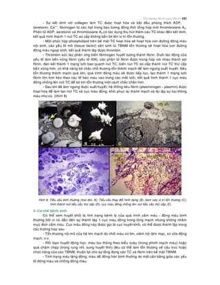 Toån thöông Huyeát quaûn-Huyeát 102
- Söï keát dính vôùi collagen laøm TC ñöôïc hoaït hoùa vaø baét ñaàu phoùng thích ADP,
seretonin, Ca++
, fibrinogen töø caùc haït trong baøo töông ñoàng thôøi toång hôïp môùi thromboxane A2.
Phaân töû ADP, seretonin vaø thromboxane A2 coù taùc duïng thu huùt theâm caùc TC khaùc ñeán keát dính,
keát quaû hình thaønh 1 nuùt TC sô caáp khoâng beàn bòt leân vò trí toån thöông.
- Moät phöùc hôïp phospholipid treân beà maët TC hoaït hoùa seõ hoaït hoùa con ñöôøng ñoâng maùu
noäi sinh, caùc yeáu toá moâ (tissue factor) saûn sinh töø TBNM toån thöông seõ hoaït hoùa con ñöôøng
ñoâng maùu ngoaïi sinh, keát quaû thaønh laäp ñöôïc thrombin.
- Thrombin xuùc taùc phaûn öùng bieán fibrinogen huyeát töông thaønh fibrin. Döôùi taùc ñoäng cuûa
yeáu toá laøm beàn vöõng fibrin (yeáu toá XIII), caùc phaân töû fibrin ñöôïc truøng hôïp vôùi nhau thaønh sôïi
fibrin, ñan keát thaønh 1 maïng löôùi bao quanh nuùt TC, bieán nuùt TC sô caáp thaønh nuùt TC thöù caáp
beàn vöõng hôn, coù khaû naêng bòt chaéc choã thöông toån thaønh maïch ñeå laøm ngöng xuaát huyeát. Neáu
toån thöông thaønh maïch quaù lôùn, quaù trình ñoâng maùu seõ ñöôïc tieáp tuïc, taïo thaønh 1 maïng löôùi
fibrin lôùn hôn keùo theo caùc teá baøo maùu vaøo trong caùc maét löôùi, keát quaû hình thaønh 1 cuïc maùu
ñoâng choàng leân nuùt TC ñeå bòt kín toån thöông moät caùch chaéc chaén hôn.
- Sau khi ñaõ laøm ngöng ñöôïc xuaát huyeát, heä thoáng tieâu fibrin (plasminogen - plasmin) ñöôïc
hoaït hoùa ñeå laøm tan nuùt TC vaø cuïc maùu ñoâng, khoâi phuïc laïi thaønh maïch vaø taùi laäp söï löu thoâng
maùu nhö cuõ. (Hình 8)
Hình 8: Tieåu caàu bình thöôøng (muõi teân, A); Tieåu caàu thay ñoåi hình daïng (B); baùm vaøo vò trí toån thöông (C);
hình thaønh nuùt tieåu caàu thöù caáp (D); cuïc maùu ñoâng choàng leân nuùt tieåu caàu thöù caáp (E).
3. Cô cheá beänh sinh
Coù theå xem huyeát khoái laø tình traïng beänh lyù cuûa quaù trình caàm maùu - ñoâng maùu bình
thöôøng bôûi vì noù daãn ñeán söï thaønh laäp 1 cuïc maùu ñoâng trong loøng maïch nhöng khoâng nhaèm
muïc ñích caàm maùu. Cuïc maùu ñoâng naøy ñöôïc goïi laø cuïc huyeát khoái, coù theå ñöôïc thaønh laäp trong
caùc tröôøng hôïp sau:
- Toån thöông noäi moâ cuûa heä tim maïch do nhoài maùu cô tim, vieâm noäi taâm maïc, xô vöõa ñoäng
maïch, v.v.
- Roái loaïn huyeát ñoäng hoïc: maùu löu thoâng theo kieåu xoaùy (trong phình maïch maùu) hoaëc
quaù chaäm chaïp (trong rung nhó, sung huyeát tónh) ñeàu coù theå laøm toån thöông veà caáu truùc hoaëc
chöùc naêng cuûa caùc TBNM, thuaän lôïi cho söï laéng ñoïng caùc TC vaø fibrin treân beà maët TBNM.
- Tình traïng maùu taêng ñoâng: maùu deã ñoâng hôn bình thöôøng do maát caân baèng giöõa caùc yeáu
toá ñoâng maùu vaø choáng ñoâng maùu.
 