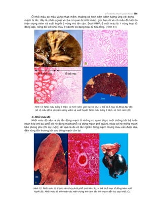 Toån thöông Huyeát quaûn-Huyeát 106
OÅ nhoài maùu coù maøu vaøng nhaït, meàm, thöôøng coù hình neâm (ñænh töông öùng vôùi ñoäng
maïch bò taéc, ñaùy laø phaàn ngoaïi vi cuûa cô quan bò nhoài maùu), giôùi haïn roõ vaø coù maàu ñoû töôi do
hieän töôïng vieâm vaø xuaát huyeát ôû vuøng moâ laân caän. Döôùi KHV, oå nhoài maùu laø 1 vuøng hoaïi töû
ñoâng ñaëc, rieâng ñoái vôùi nhoài maùu ôû naõo thì coù daïng hoaïi töû hoùa loûng. (Hình 14)
Hình 14: Nhoài maùu traéng ôû thaän, coù hình neâm, giôùi haïn roõ (A); vi theå laø oå hoaïi töû ñoâng ñaëc (B);
bôø roõ maàu ñoû laø do hieän töôïng vieâm vaø xuaát huyeát. Nhoài maùu traéng ôû laùch, coù hình neâm (D).
b/ Nhoài maùu ñoû:
Nhoài maùu ñoû xaûy ra do taéc ñoäng maïch ôû nhöõng cô quan ñöôïc nuoâi döôõng bôûi heä tuaàn
hoaøn keùp (thí duï: phoåi coù heä ñoäng maïch phoåi vaø ñoäng maïch pheá quaûn), hoaëc coù heä thoáng maïch
beân phong phuù (thí duï: ruoät); keát quaû laø duø coù taéc ngheõn ñoäng maïch nhöng maùu vaãn ñöôïc ñöa
ñeán vuøng toån thöông bôûi caùc ñoäng maïch coøn laïi.
Hình 15: Nhoài maùu ñoû ôû cöïc treân thuøy döôùi phoåi (muõi teân, A); vi theå laø oå hoaïi töû ñoâng keøm xuaát
huyeát (B). Nhoài maùu ñoû tinh hoaøn do xoaén thöøng tinh laøm taéc tónh maïch daãn löu duy nhaát (C).
 