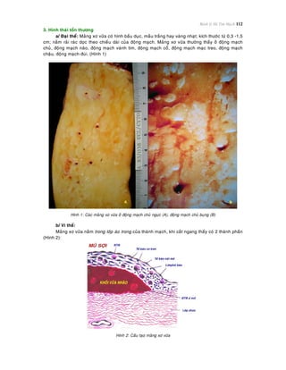 Bệnh lý Hệ Tim Mạch 112
3. Hình thaùi toån thöông
a/ Ñaïi theå: Maûng xô vöõa coù hình baàu duïc, maàu traéng hay vaøng nhaït; kích thöôùc töø 0,3 -1,5
cm; naèm raûi raùc doïc theo chieàu daøi cuûa ñoäng maïch. Maûng xô vöõa thöôøng thaáy ôû ñoäng maïch
chuû, ñoäng maïch naõo, ñoäng maïch vaønh tim, ñoäng maïch coå, ñoäng maïch maïc treo, ñoäng maïch
chaäu, ñoäng maïch ñuøi. (Hình 1)
Hình 1: Caùc maûng xô vöõa ôû ñoäng maïch chuû ngöïc (A), ñoäng maïch chuû buïng (B)
b/ Vi theå:
Maûng xô vöõa naèm trong lôùp aùo trong cuûa thaønh maïch, khi caét ngang thaáy coù 2 thaønh phaàn
(Hình 2):
Hình 2: Caáu taïo maûng xô vöõa
 